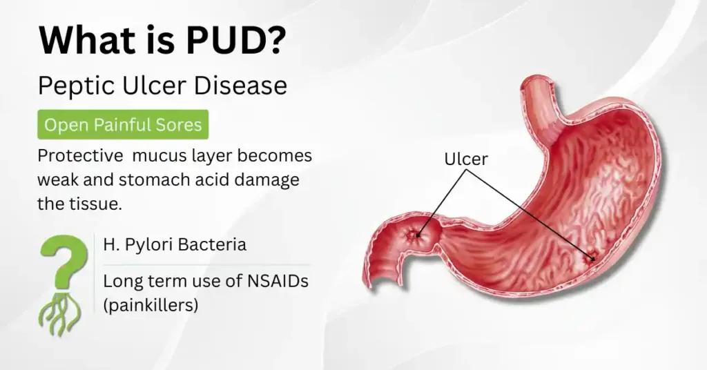 What is PUD? Peptic Ulcer Disease: open painful sores caused by H. Pylori or NSAIDs. Diagram shows stomach ulcers
