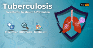 Tuberculosis